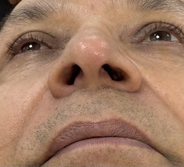 Nose hair removal - After